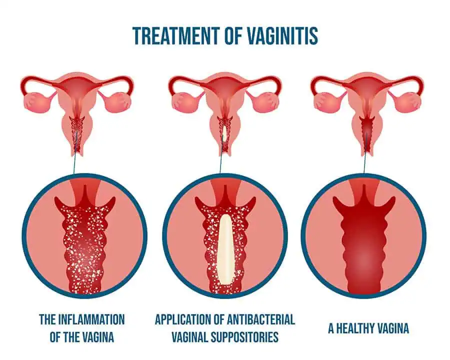 vaginitis